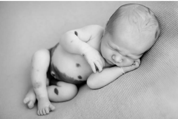 newborn baby with marks on skin